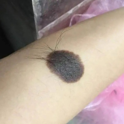 黑毛痣对人体的危害性有哪些?
